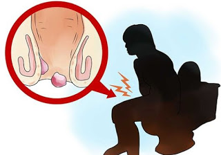 Obat alami untuk benjolan wasir, cara mengobati ambeyen kecil, obat untuk penyakit ambeien yang paling ampuh, cara mengobati sakit ambeyen secara alami, obat buat penyakit wasir yg ada di apotik, obat untuk penyakit wasir di palopo, cara jitu mengobati penyakit ambeyen, obat buat penyakit ambeien medan, biaya pengobatan penyakit ambeyen dengan beim, indikasi penyakit ambeien atau wasir, bab berdarah setelah operasi ambeien